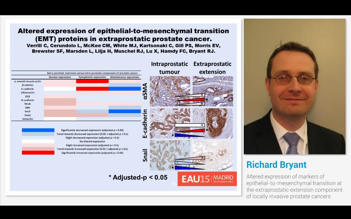 Altered expression of markers of epithelial-to-mesenchyma..-