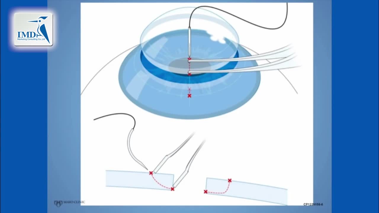 角膜缝合手术操作步骤（2）