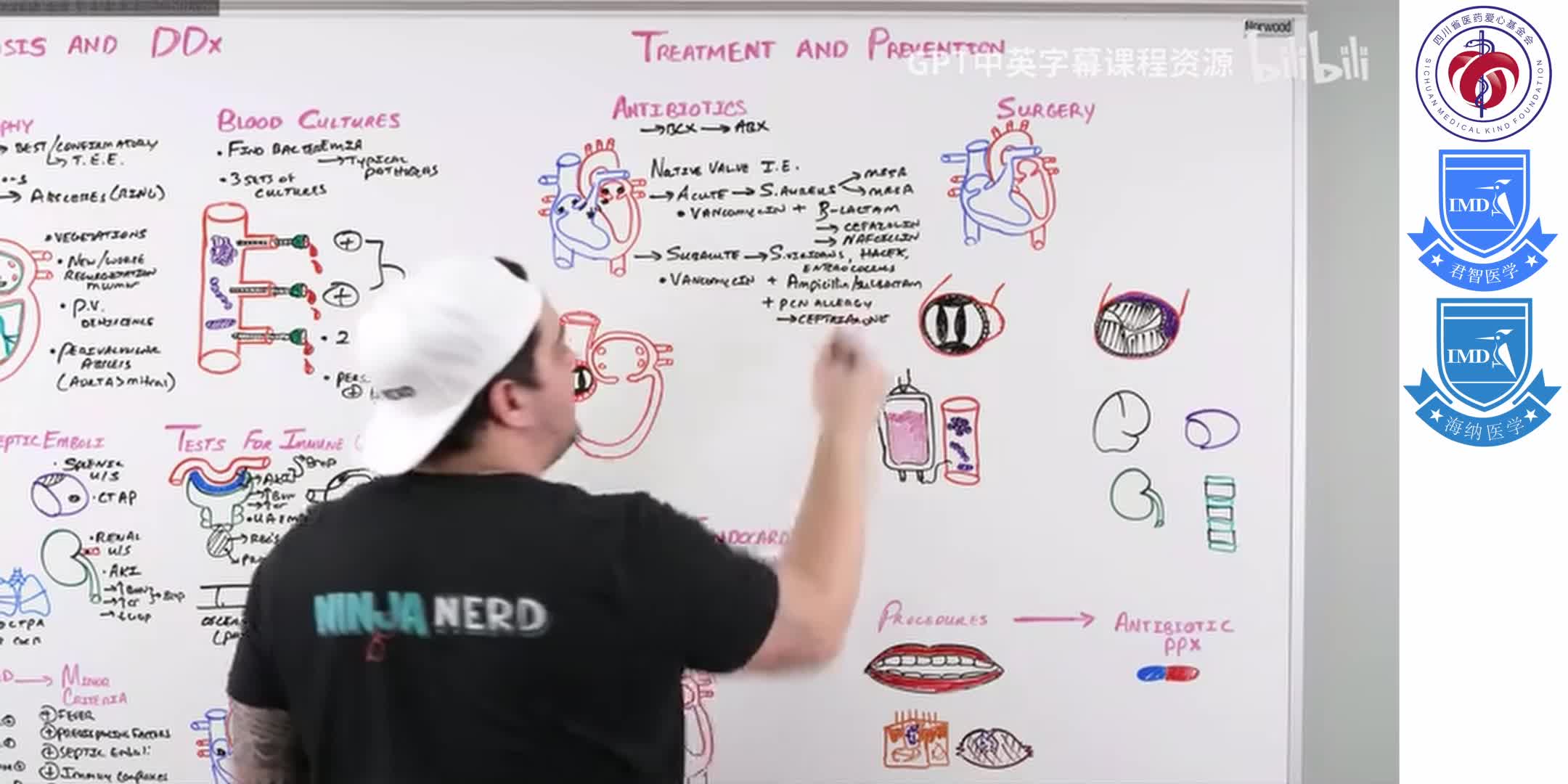 Infective Endocarditis 11