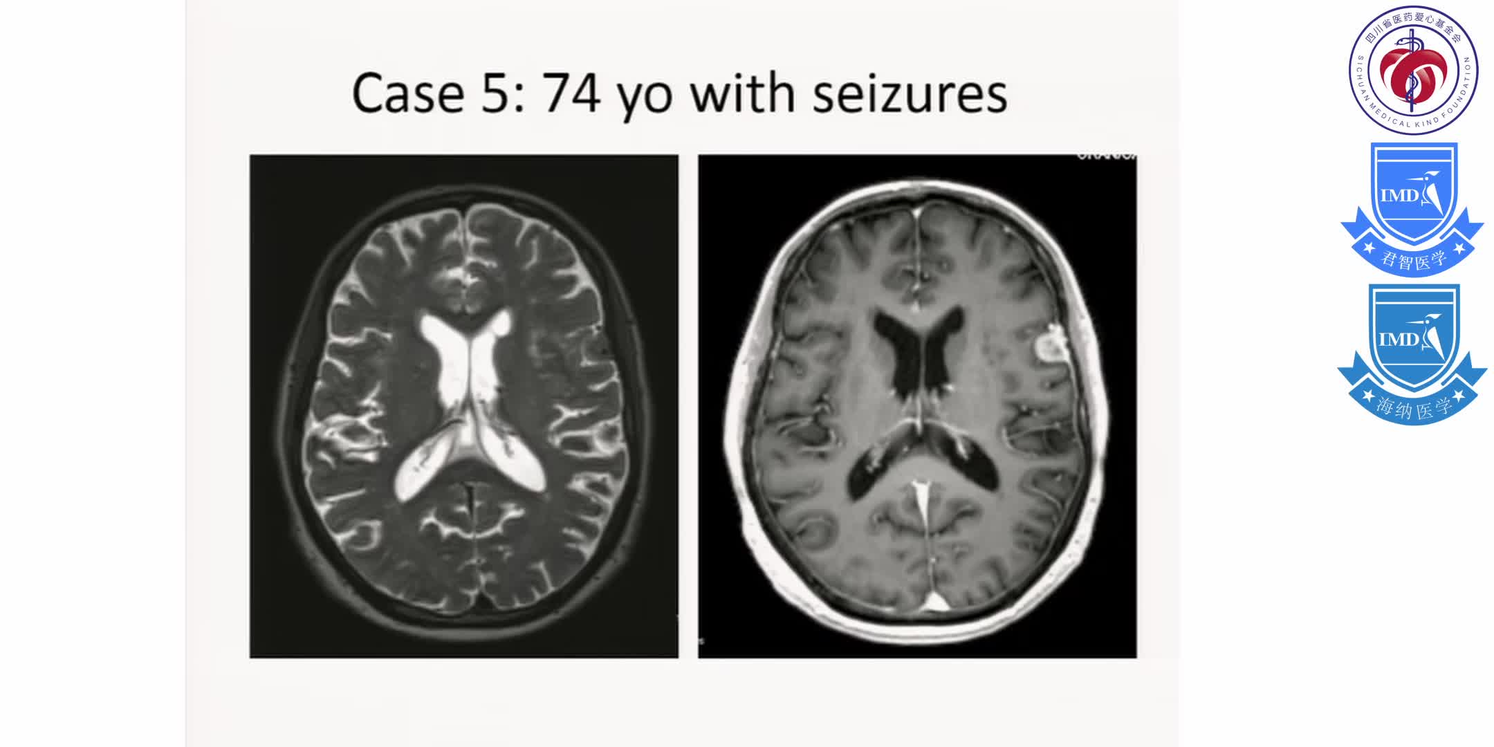 Initial Treatment, Including Scenarios Requiring Urgent and Multi-disciplinary Management for Primary Brain Tumors 13