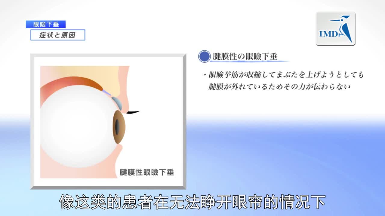 眼科--眼睑下垂的诊断与治疗（2）