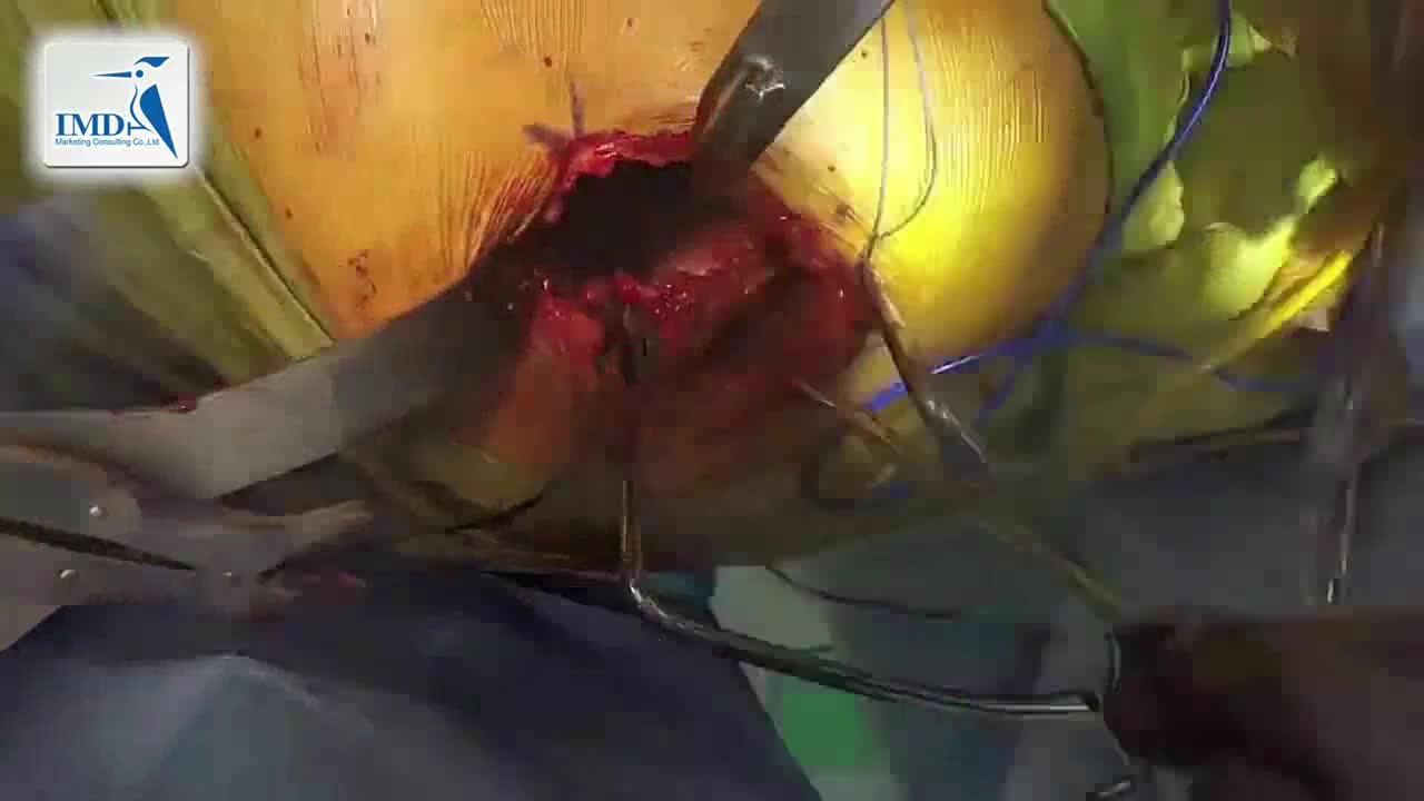 后入路髋关节微创手术（2）