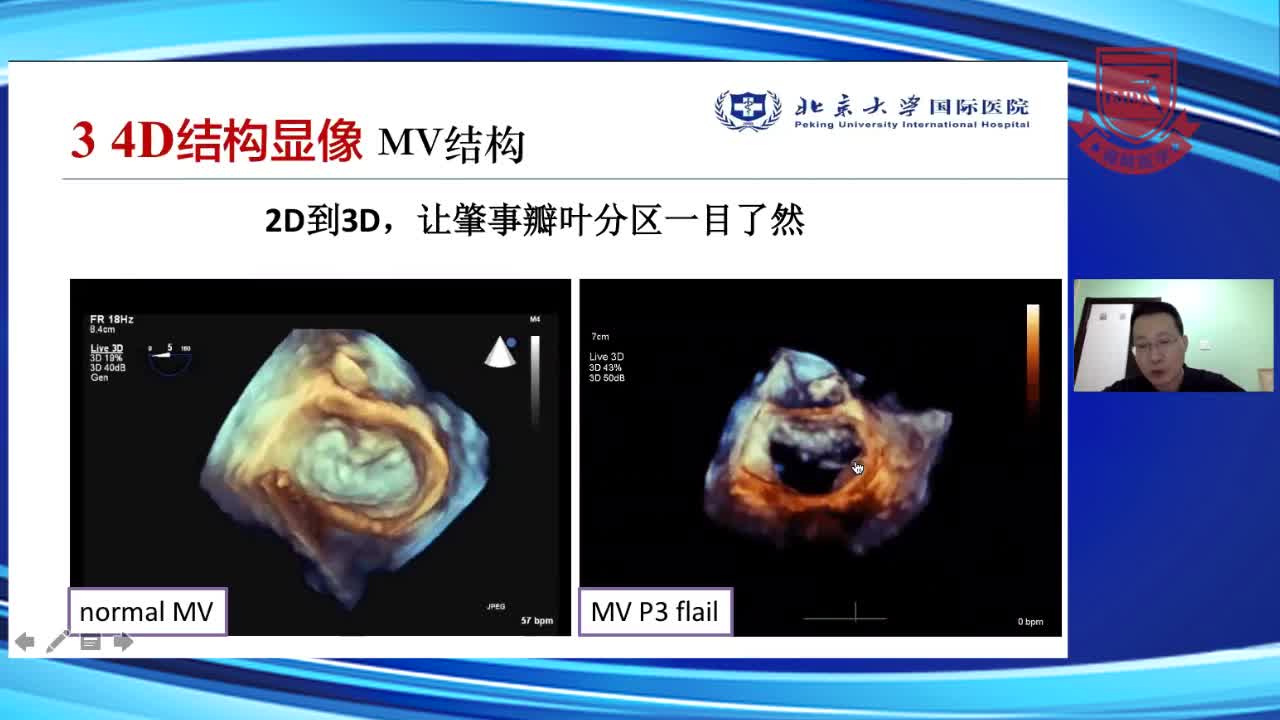 从&ldquo;结构显像&rdquo;到&ldquo;容积定量&rdquo;34D TEE在心脏手术中的应用--朱斌（2）