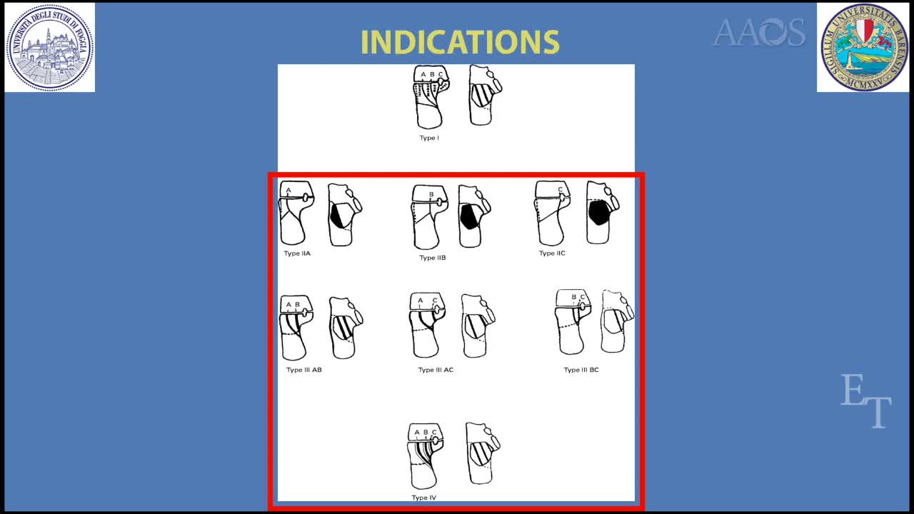 BALLOON ASSISTED REDUCTION, PIN FIXATIONAND TRICALCIUM PHOSPHATE AUGMENTATION FOR CALCANEAR FRACTURE SURGICAL TECNIQUE