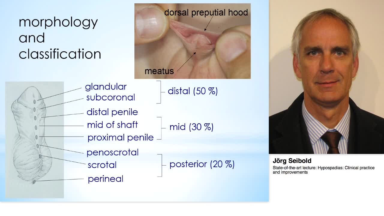 Hypospadias, Clinical practice and improvements