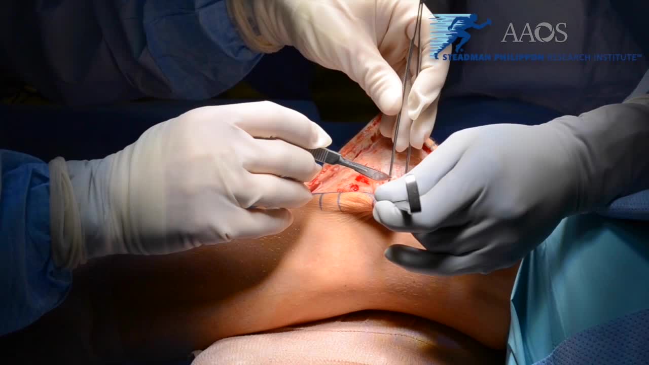 Fresh Osteochondral Allograft Surgical Technique