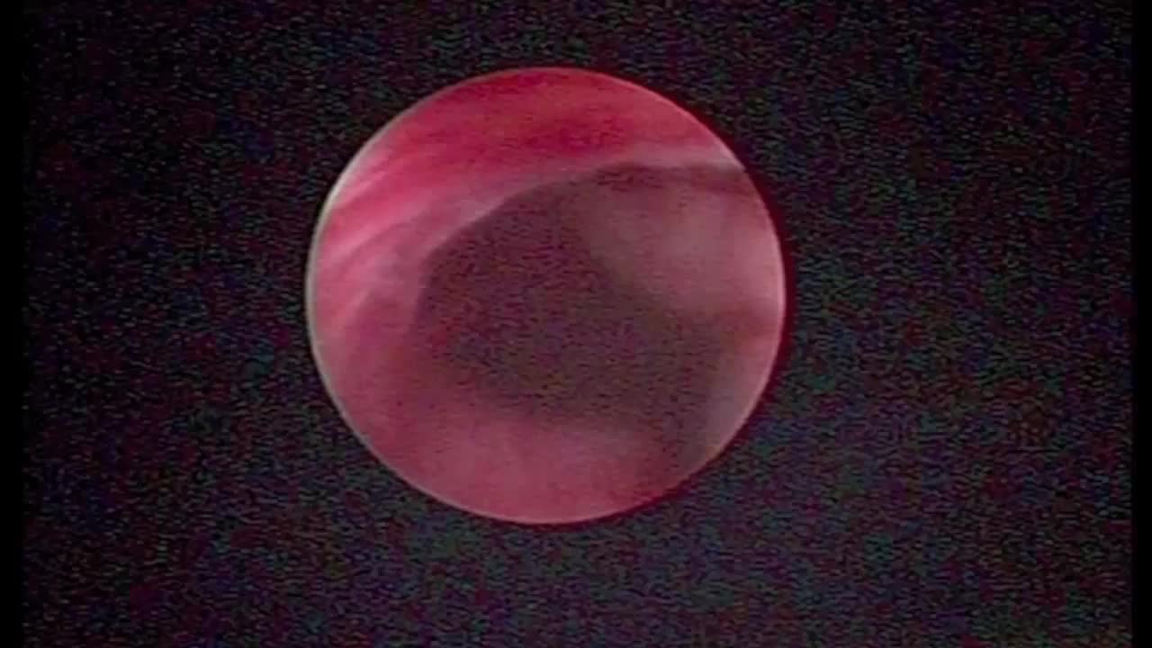 En bloc holmium laser resection of UTUC by percutaneous a..-