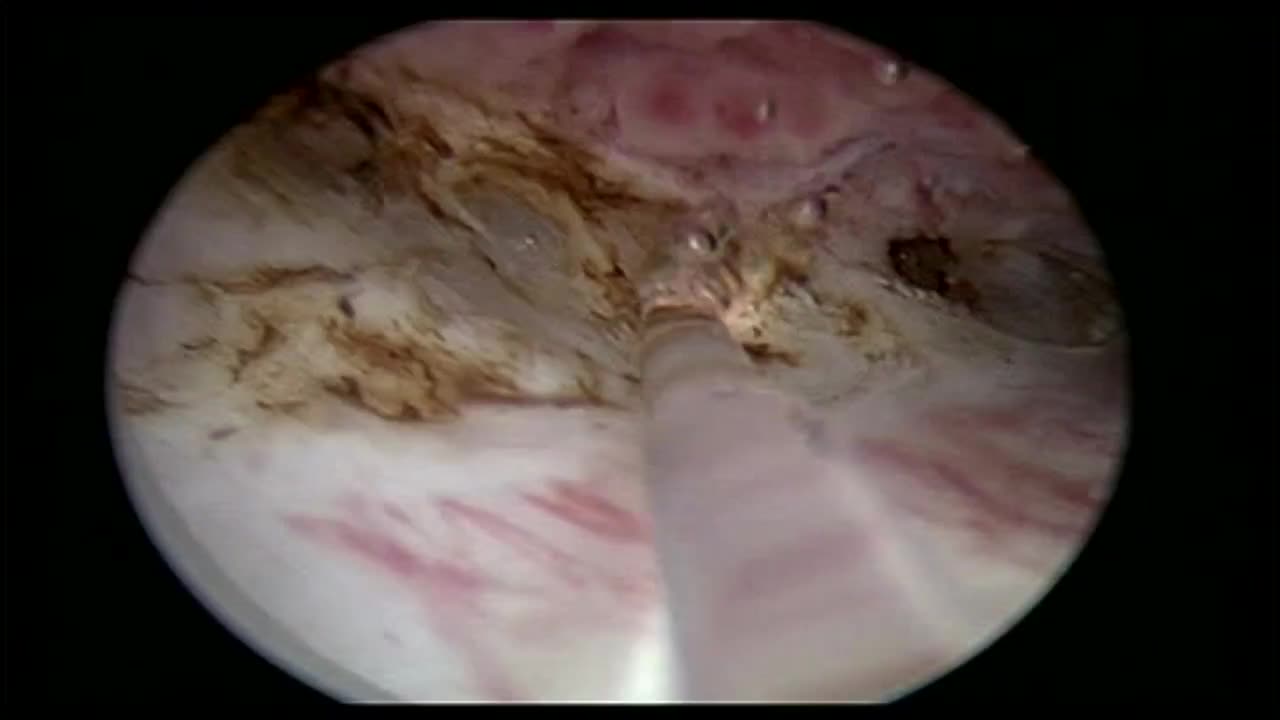 En bloc thulium laser resection of bladder tumours, Indic..-