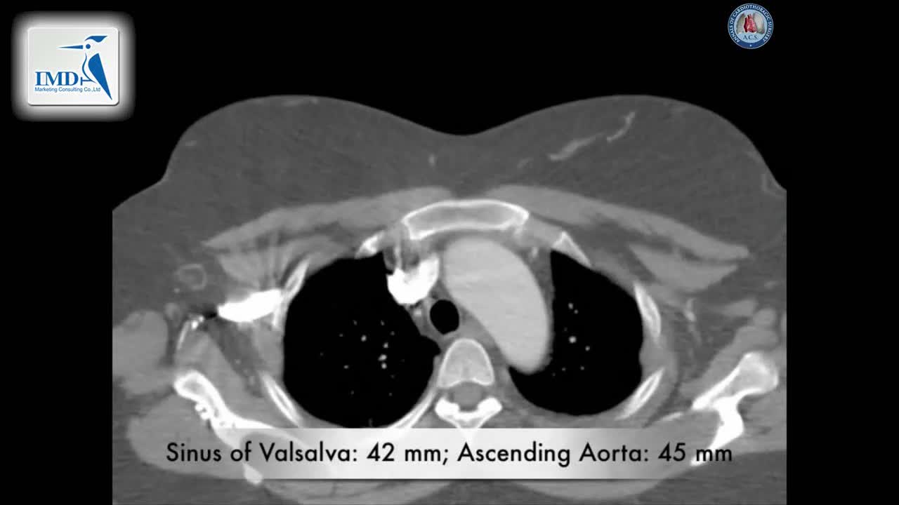 Bentall（复合带瓣管道）手术