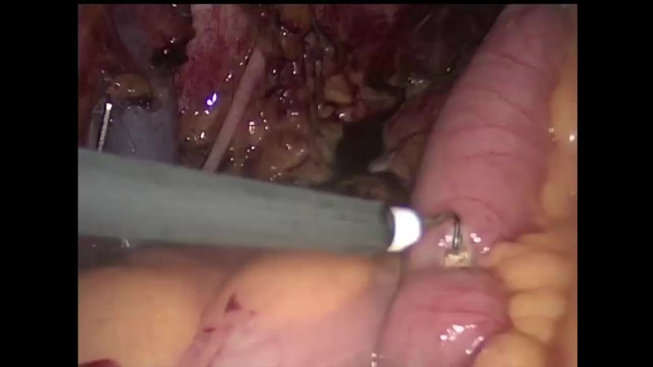 Totally intracorporeal laparoscopic radical cystectomy wi..-