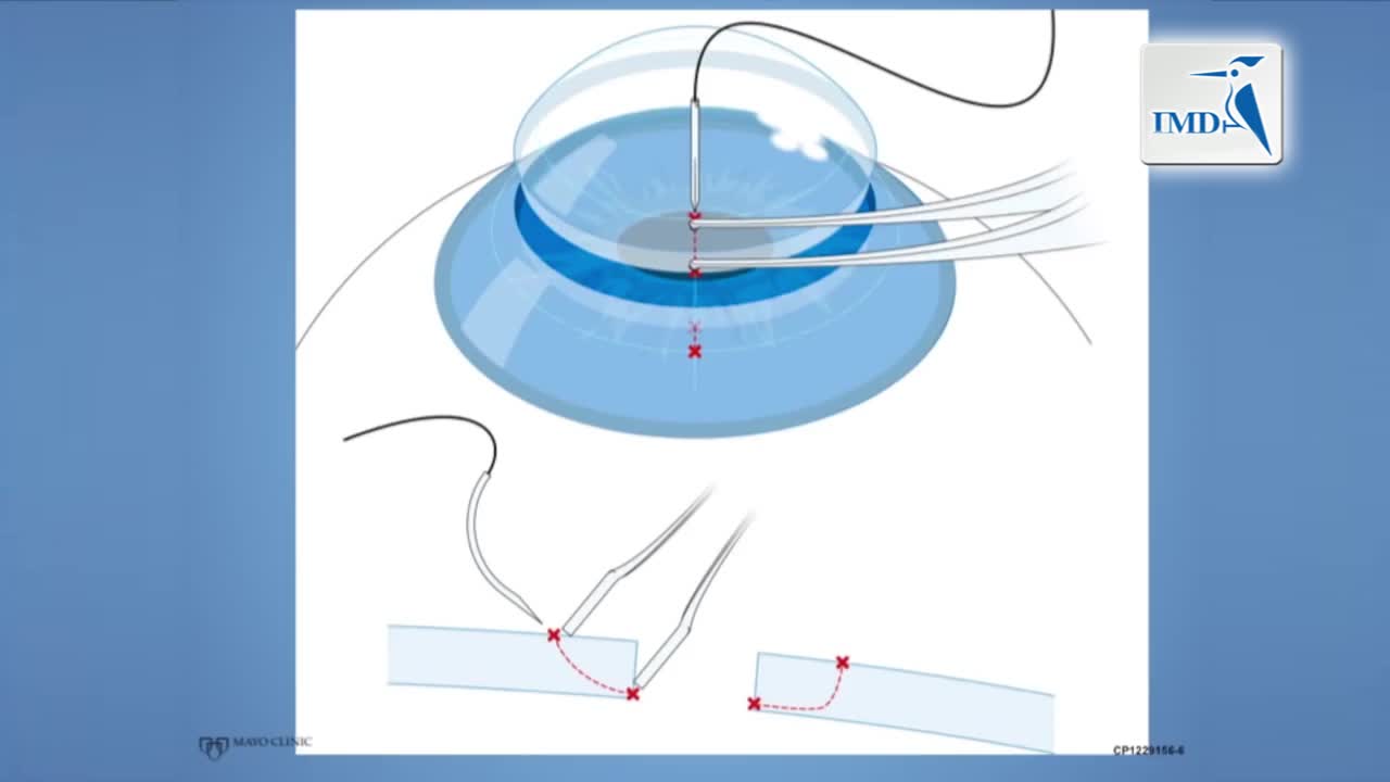 眼科--角膜缝合手术操作步骤（2）