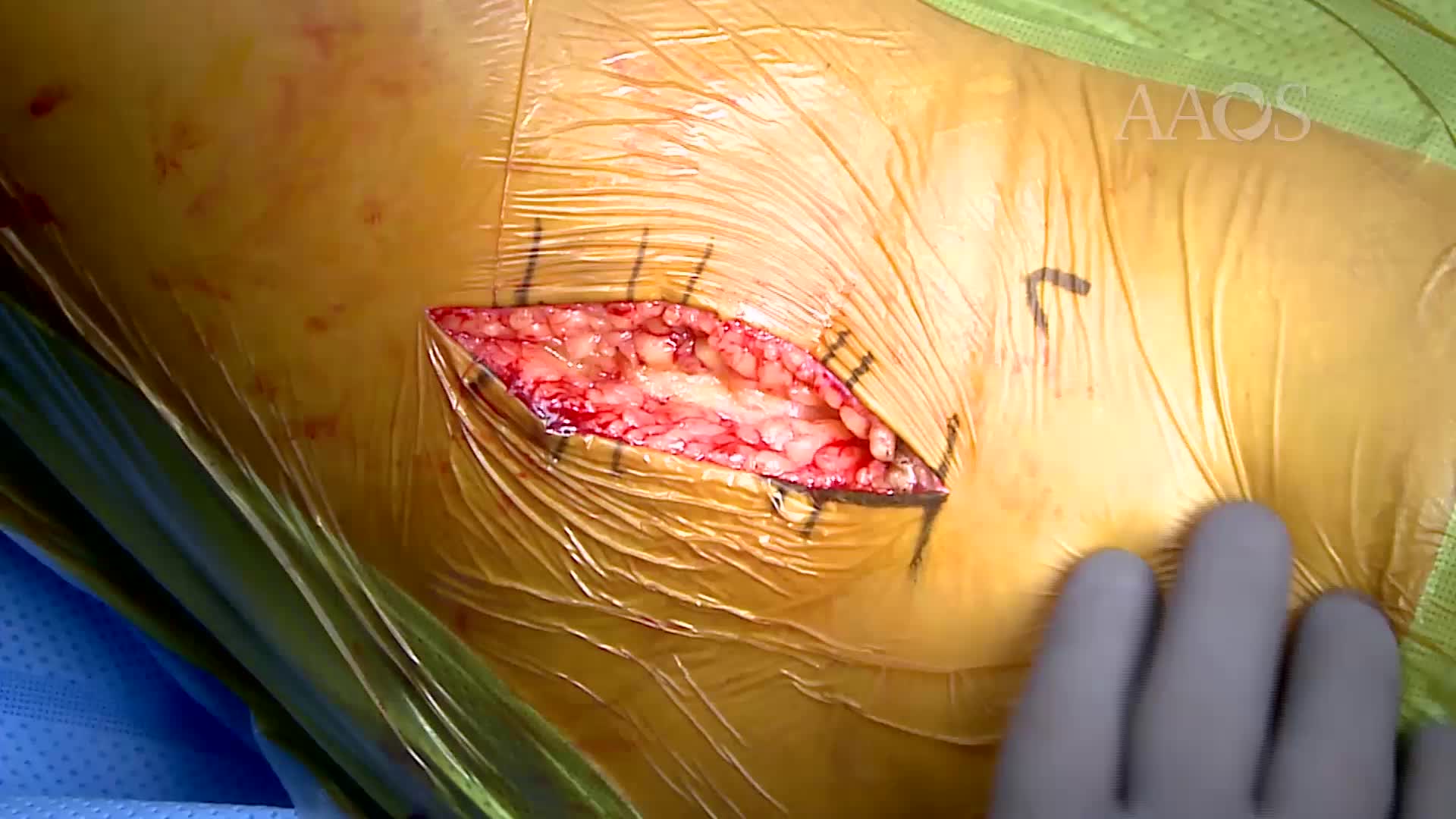Effective Exposure andCapsule ManagementTechniques in Anterior THA