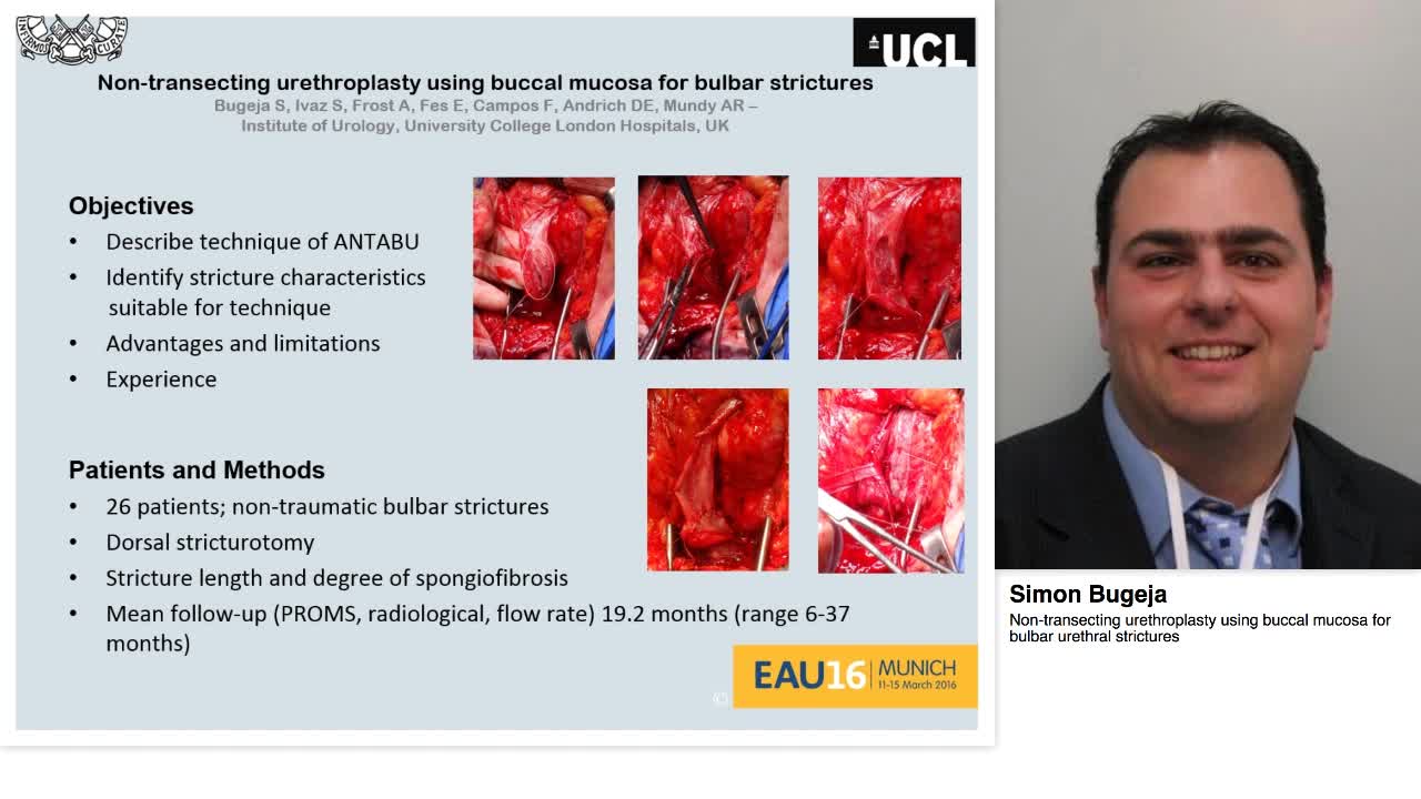 Non-transecting urethroplasty using buccal mucosa for bul-
