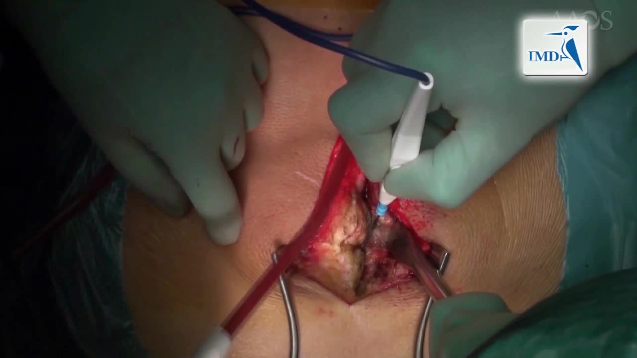 如何减轻严重不平衡狭窄性脊椎前移（2）