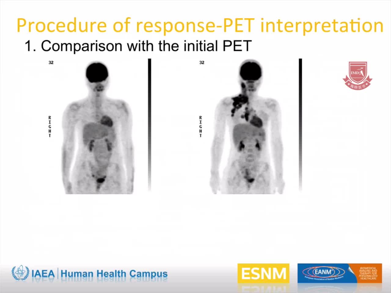 PET CT在儿童淋巴瘤中的应用2