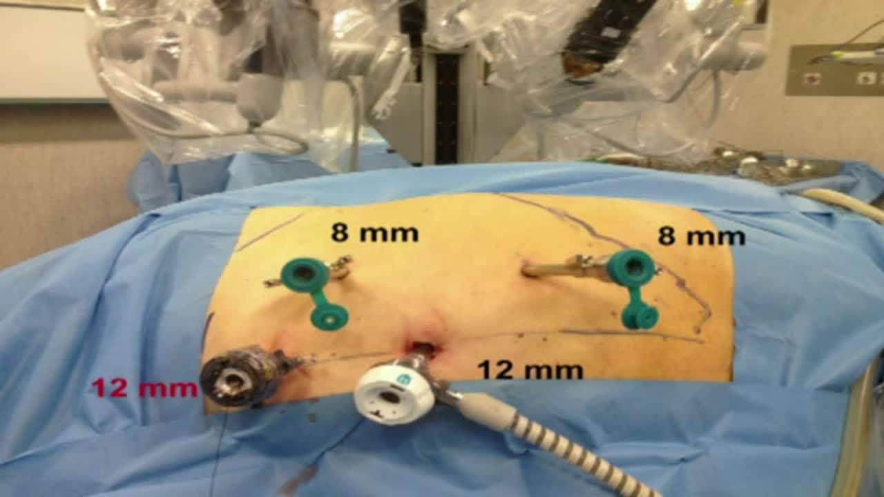 Simultaneous bilateral robotic partial nephrectomy, The d..-
