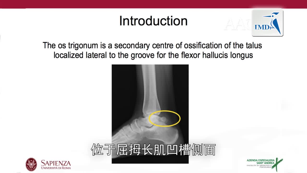 后跟法症状性距后三角骨内窥镜切除术（1） (1)