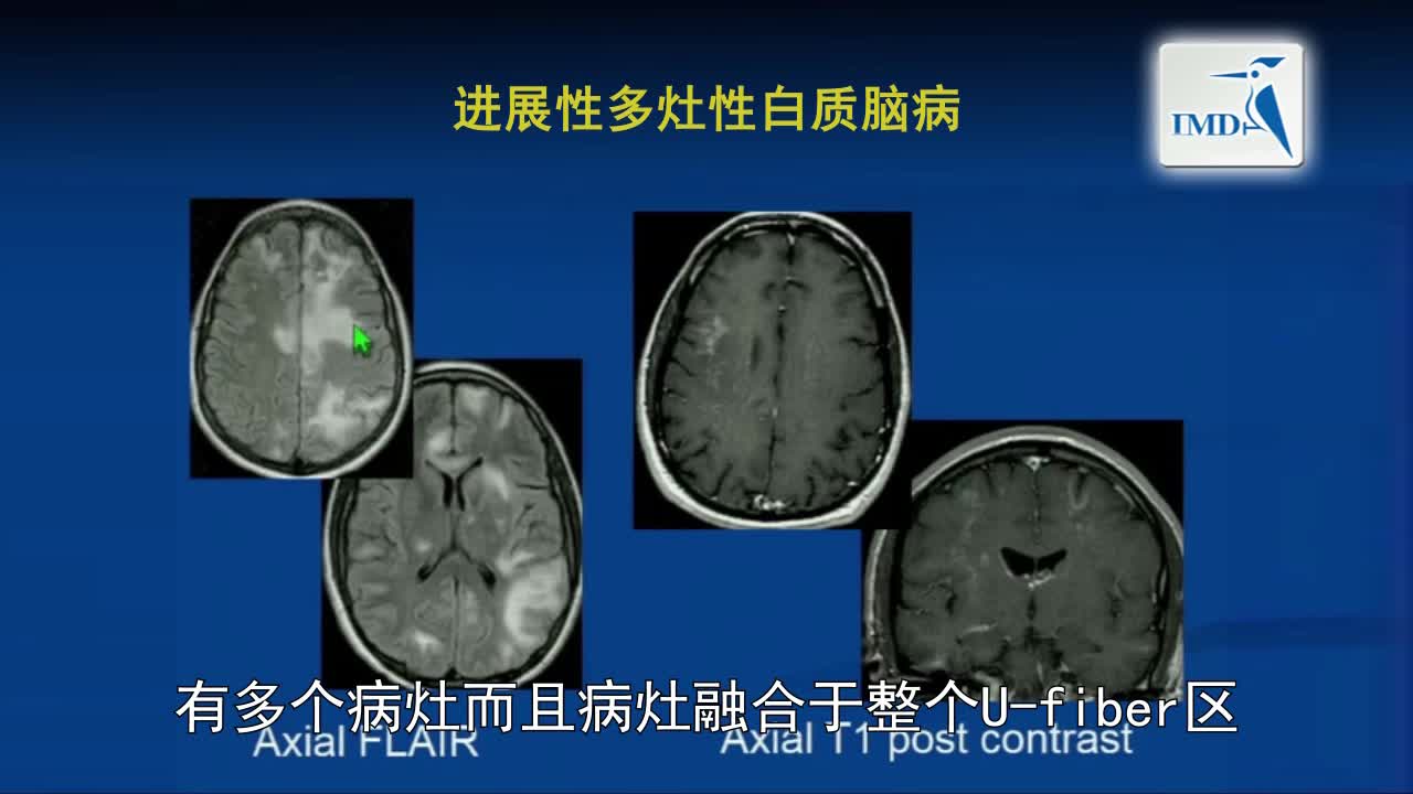 MRI与MS：一幅图是否值得冗言赘述（6）