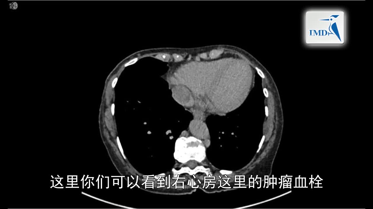治疗心肾肿瘤中的当代开腹手术技巧