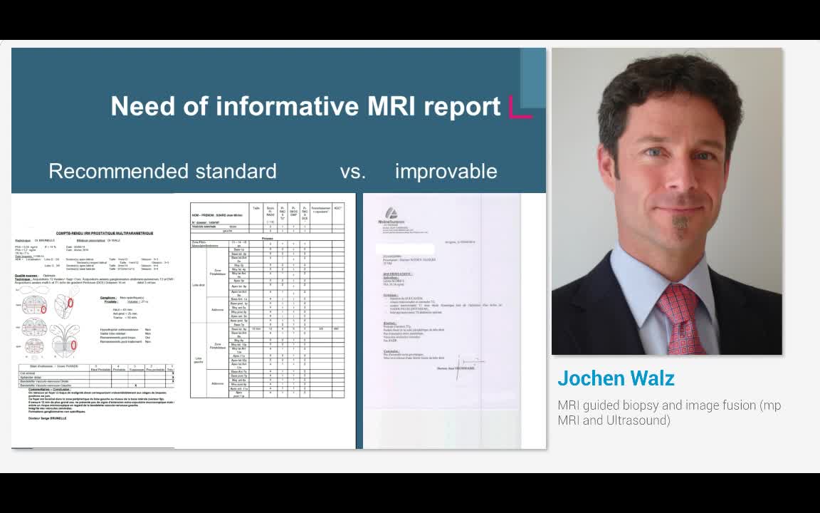 MRI guided biopsy and image fusion (mp MRI and Ultrasound)