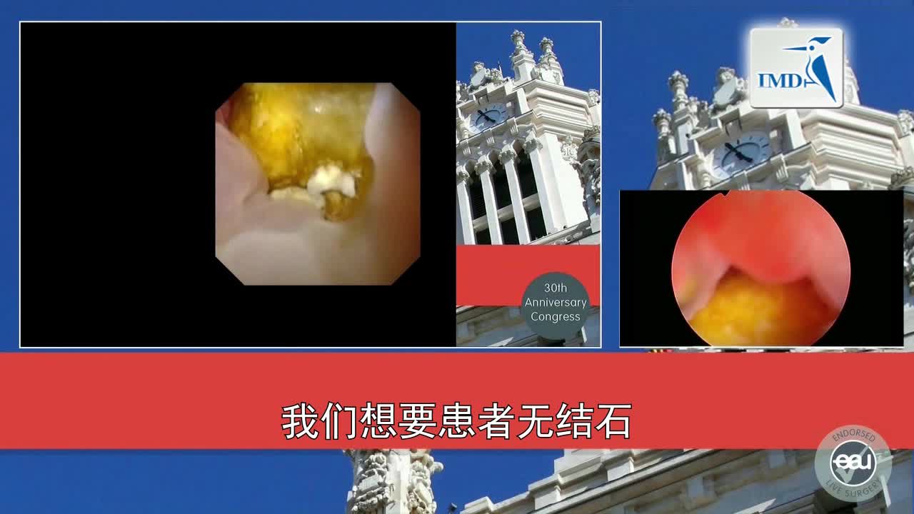 数字技术在肾结石手术中的运用（4）