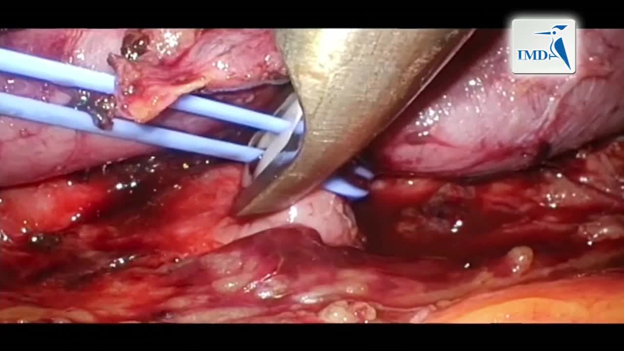 腹腔镜手术取栓及下腔静脉缝合经验