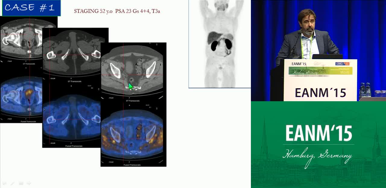 11C或18F胆碱在诊断分期、复发和检测隐匿性复发中的作用
