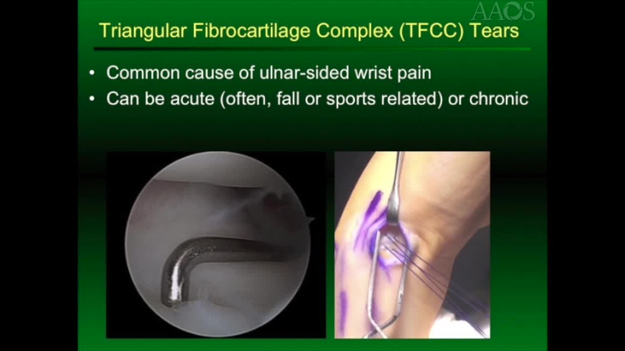 Arthroscopic-Assisted Outside-In Repair ofTriangular Fibrocartilage Complex Tears