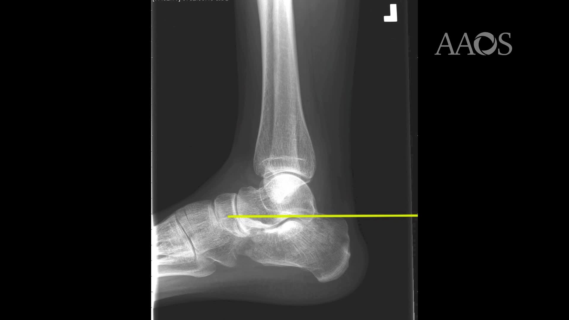 Displaced Intra-articularCalcaneal Fracture