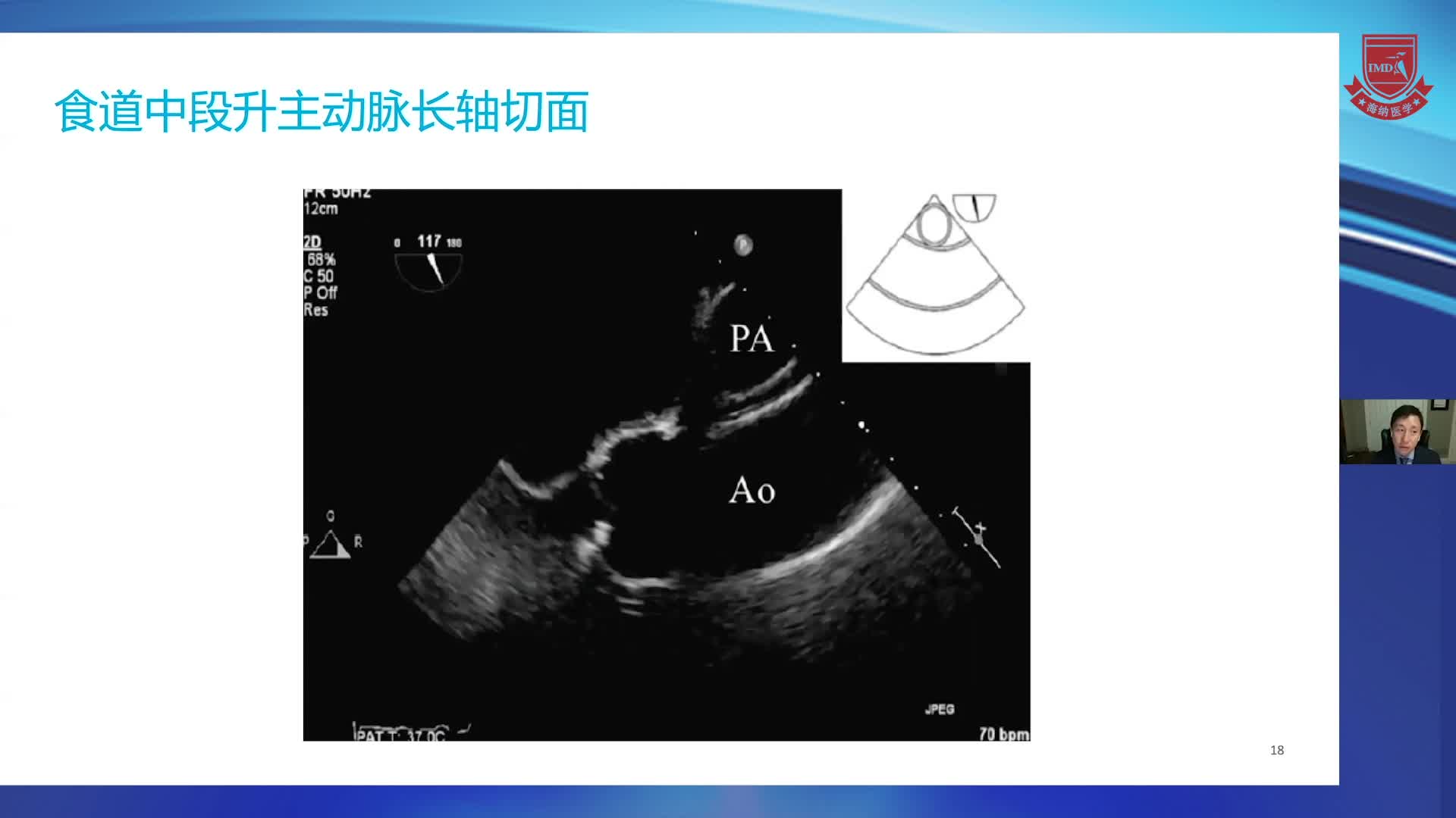 TEE常用切面之经食道心脏超声常用切面 黄佳鹏 _2