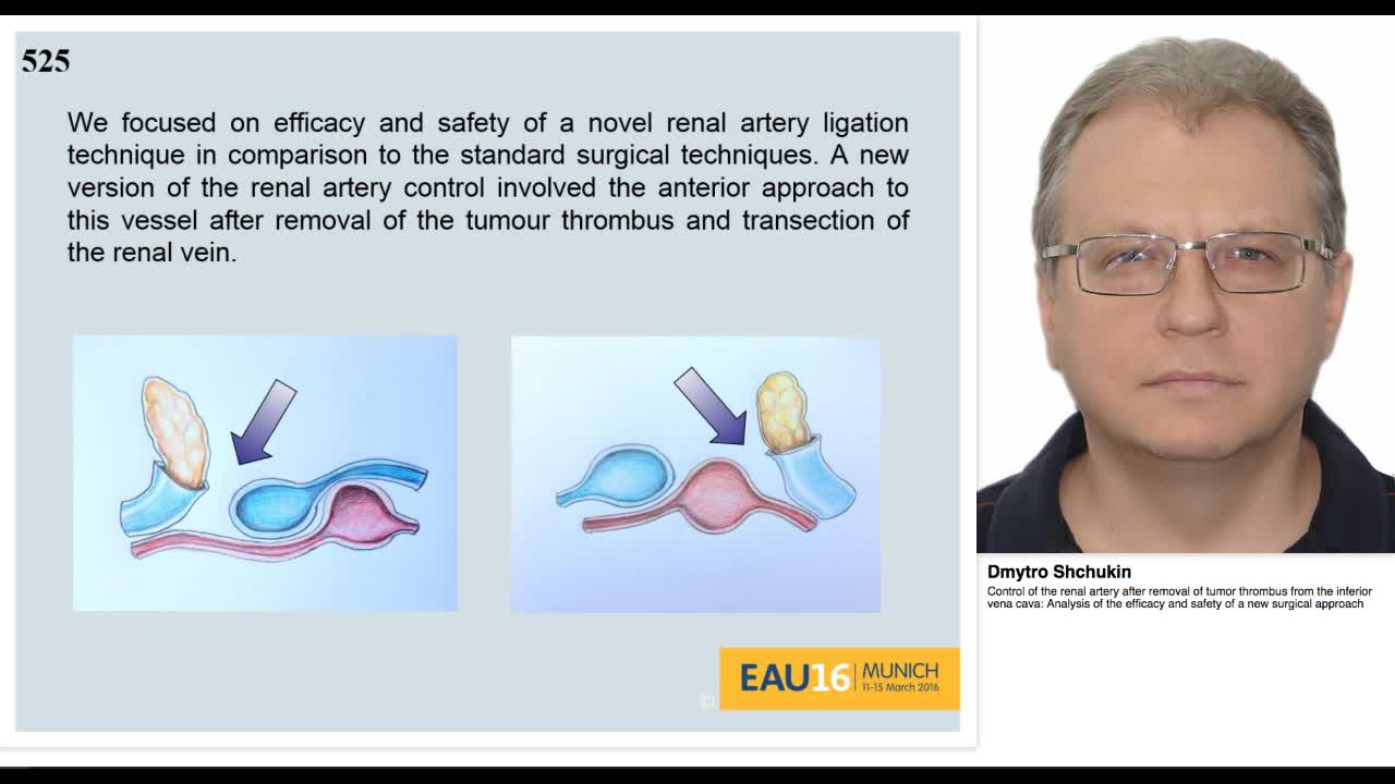 Control of the renal artery after removal of tumor thromb-