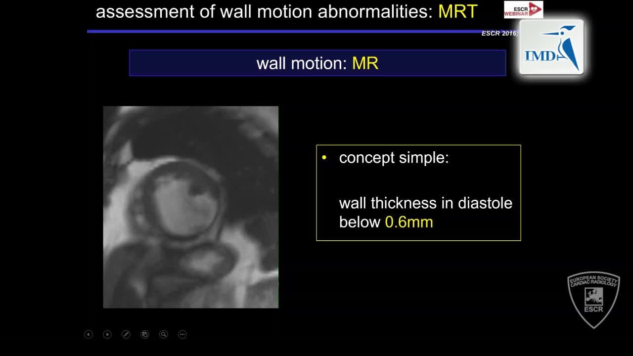 急性冠状动脉综合征发作后的影像诊断（5）