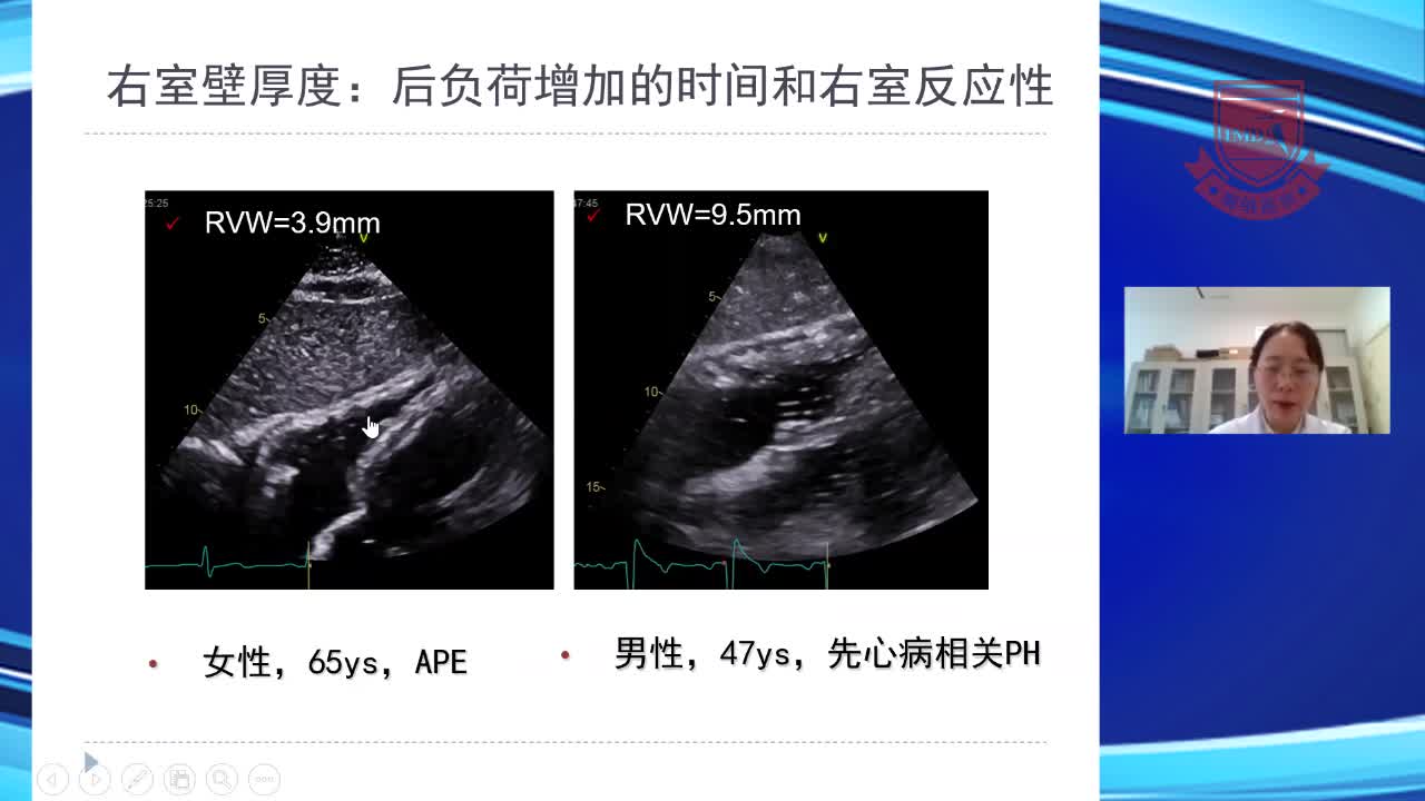 右心功能的超声心动图评估--李爱莉2