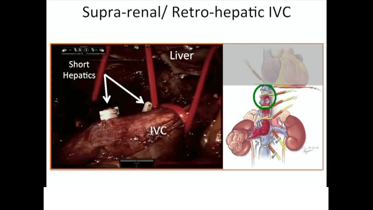 Robotic level II and III IVC thrombectomy, Technical inno..-