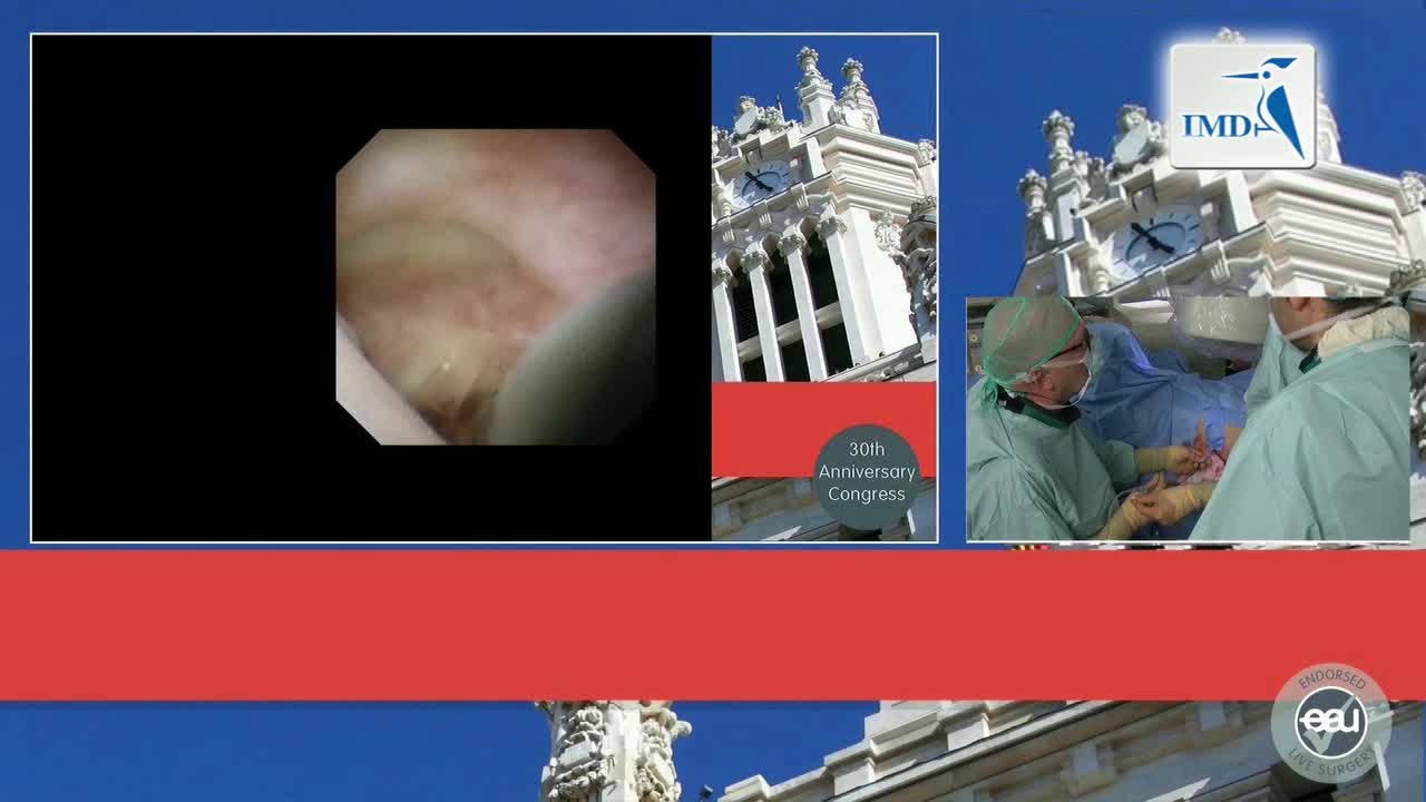 数字技术在肾结石手术中的运用（2）