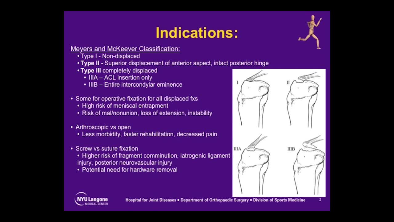 Tibial Spine Avulsion Fracture
