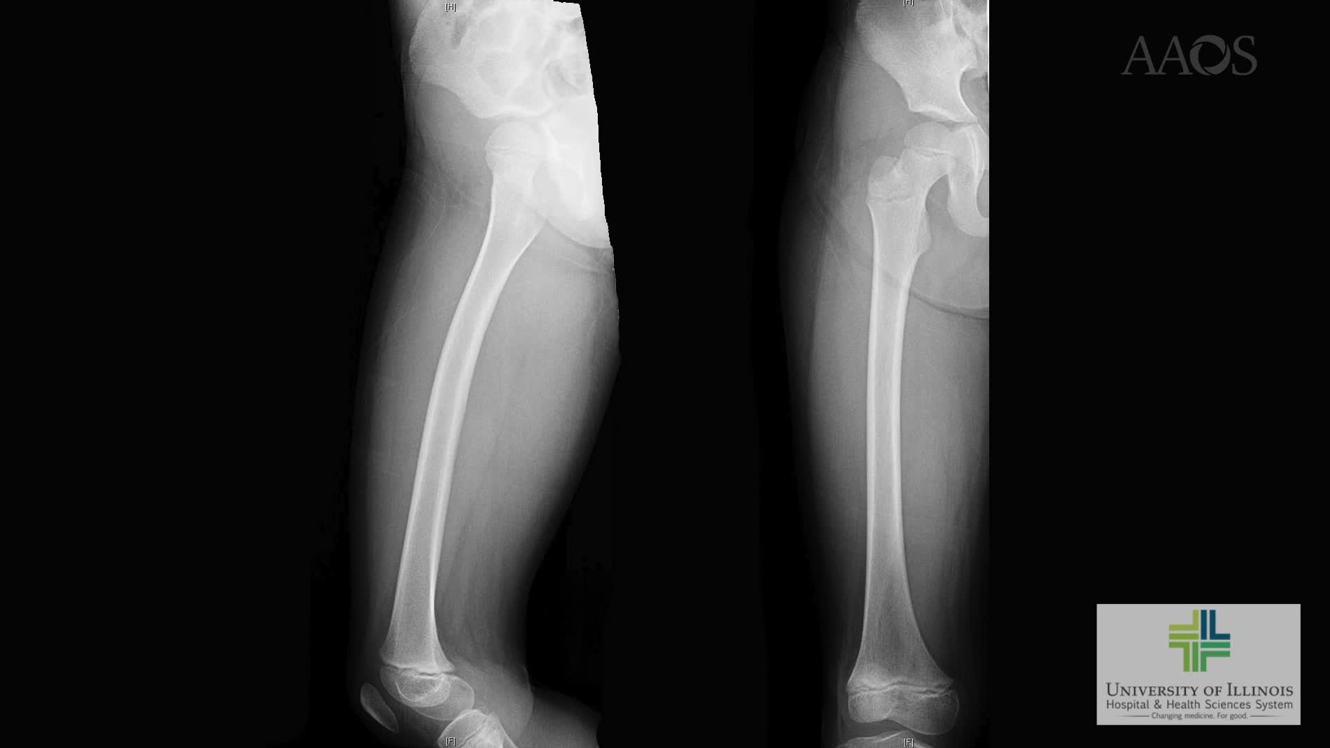 Single Portal Hip Arthroscopy for Septic Arthritis in the Pediatric Patient