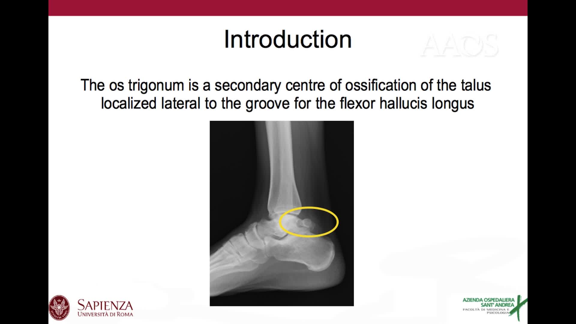 ENDOSCOPIC EXCISIONOF SYMPTOMATIC OS TRIGONUM BY POSTERIOR HINDFOOT APPROACH