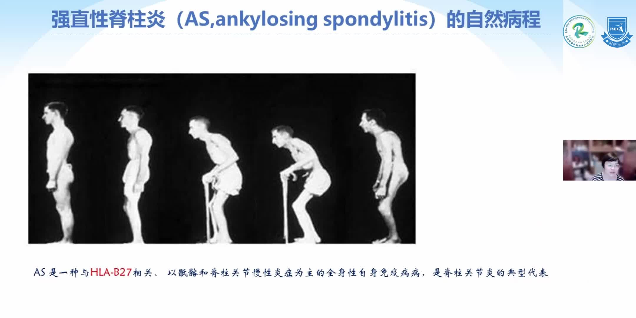 朱静-脊柱关节炎的规范化诊治（1）