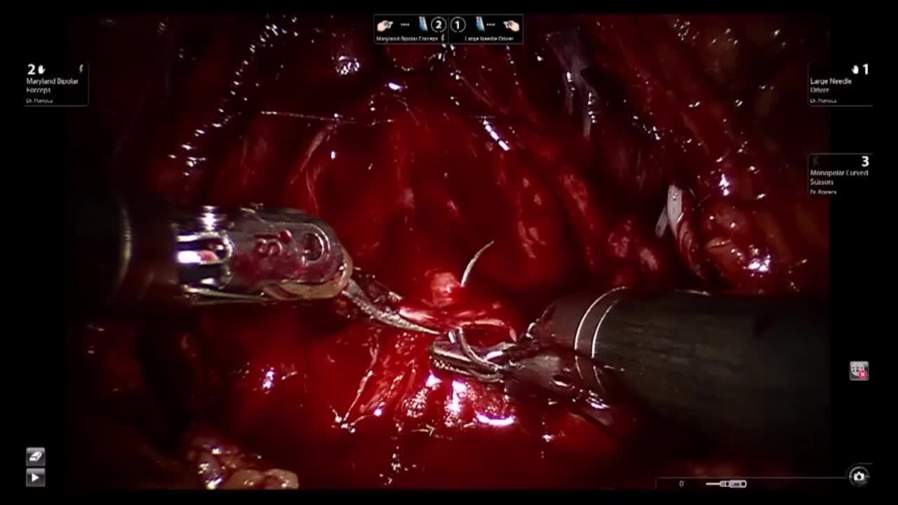 A new single barbed bidirectional suture (Filbloc, Assut ..-