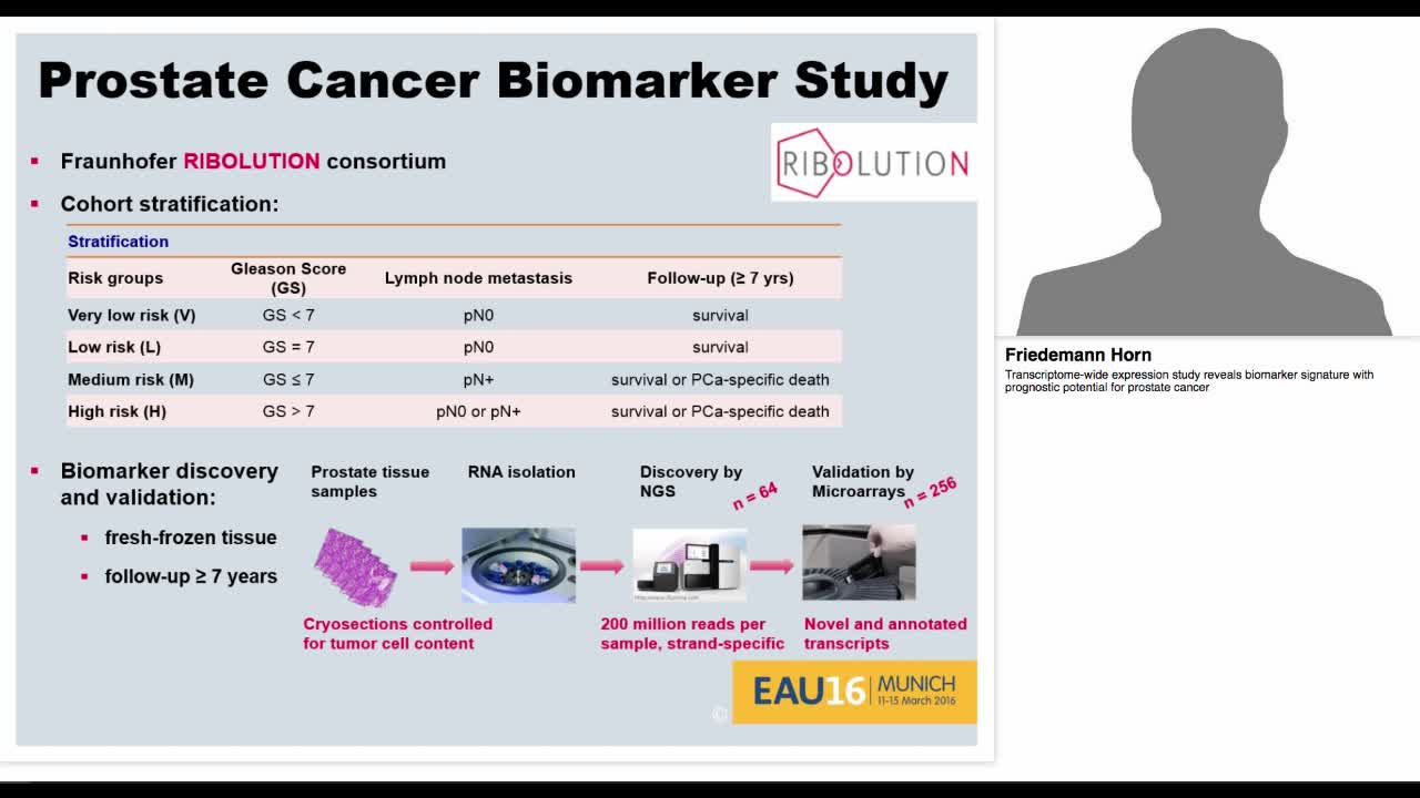 Transcriptome-wide expression study reveals biomarker sig-