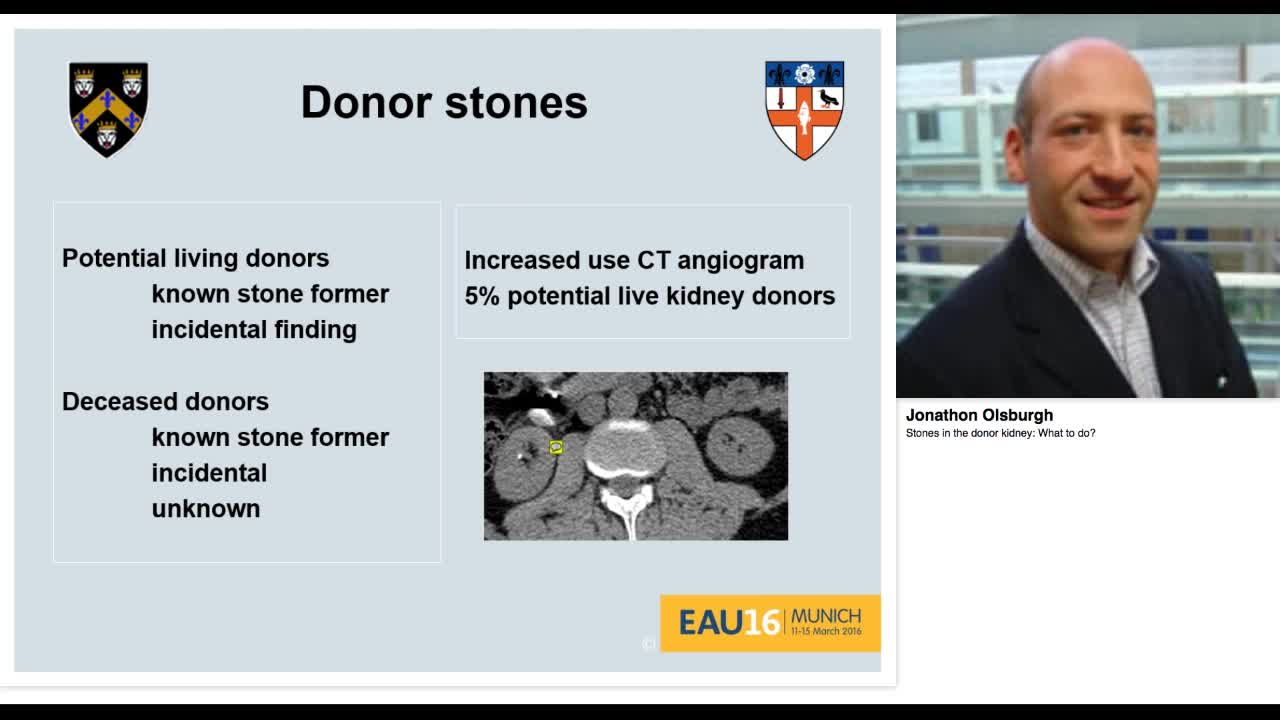 Stones in the donor kidney, What to do.