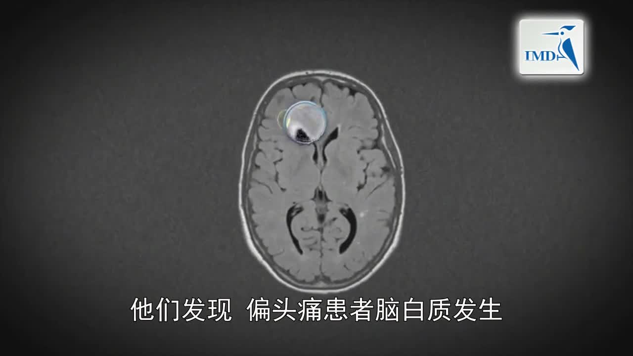 与脑病变高发相关女性偏头痛