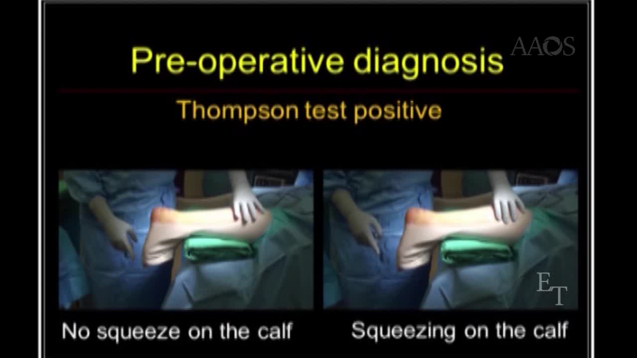 Endoscopically assisted percutaneous Achilles tendon repair