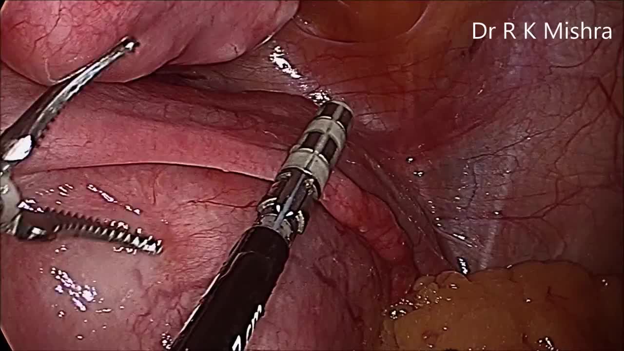 腹腔镜子宫切除术