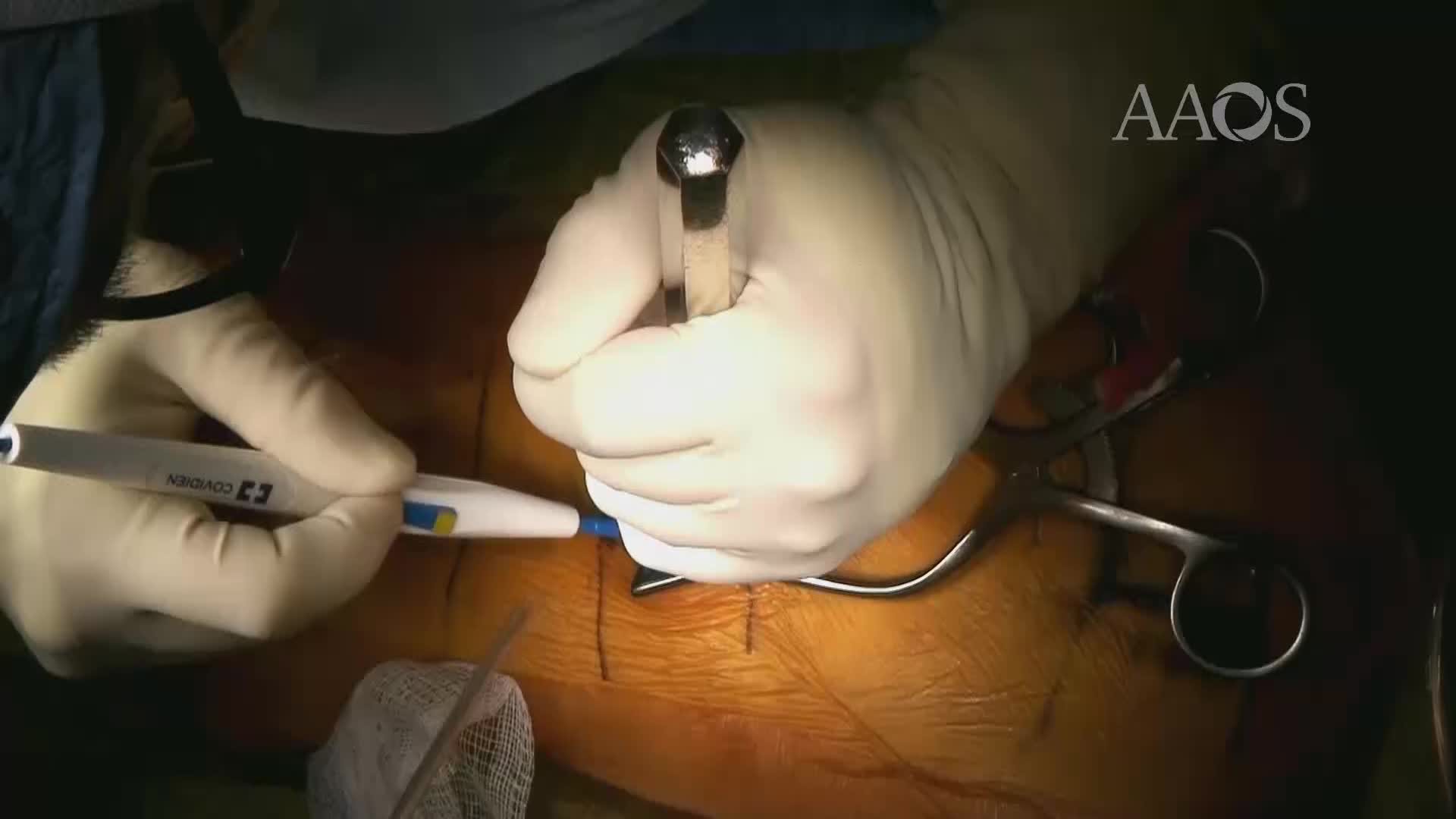 Placement of BilateralMagnetically Activated Growing Rods