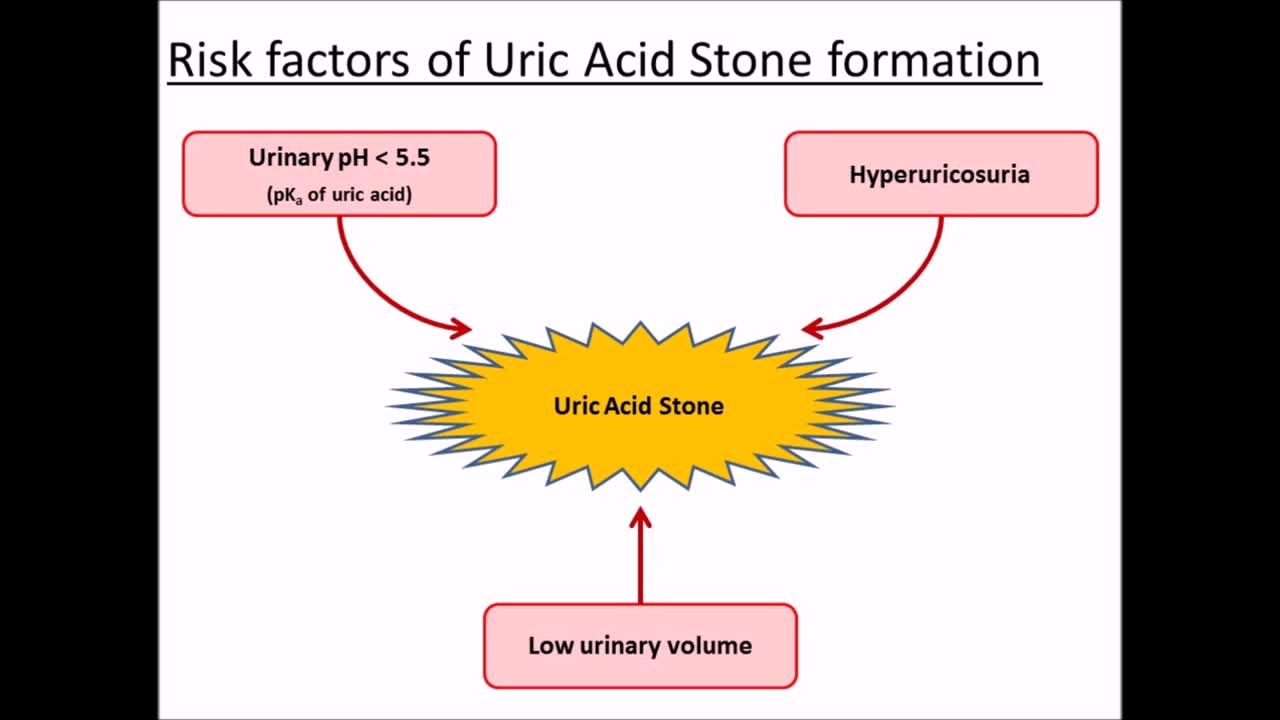 Urine acidity is the most important factor in uric acid s..-