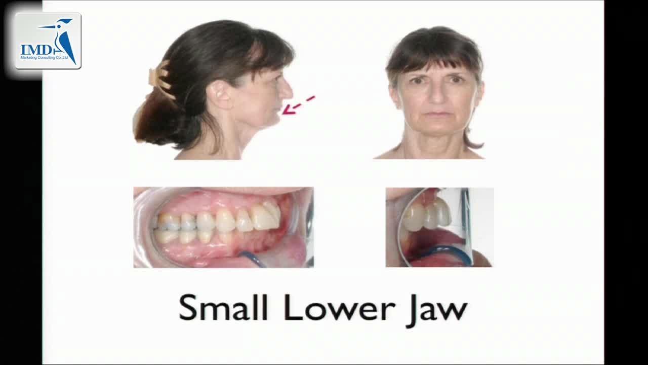 下巴微创整形手术（2）