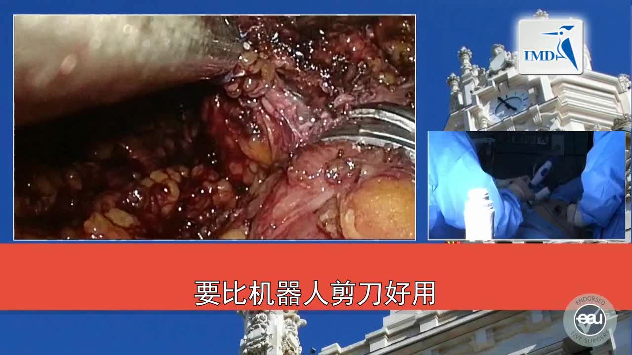 3D-HD腹腔镜肾部分切除术（3）