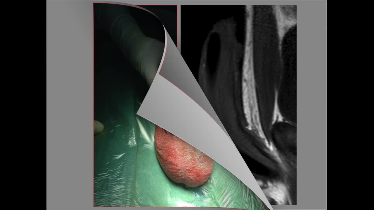 Bilateral impending distal erosion of soft penile implant..-